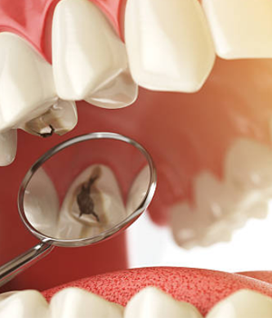 Dental Implants on the Danforth