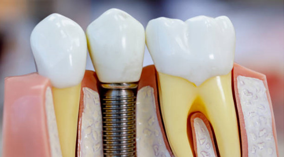 dental implants Toronto