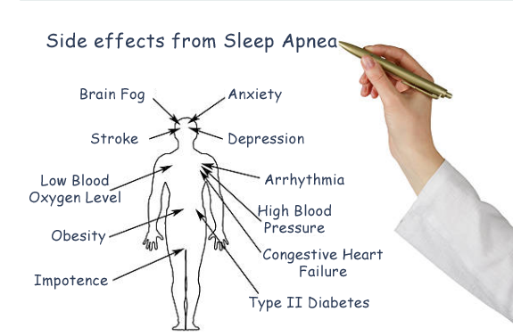 Dental Appliance for Sleep Apnea